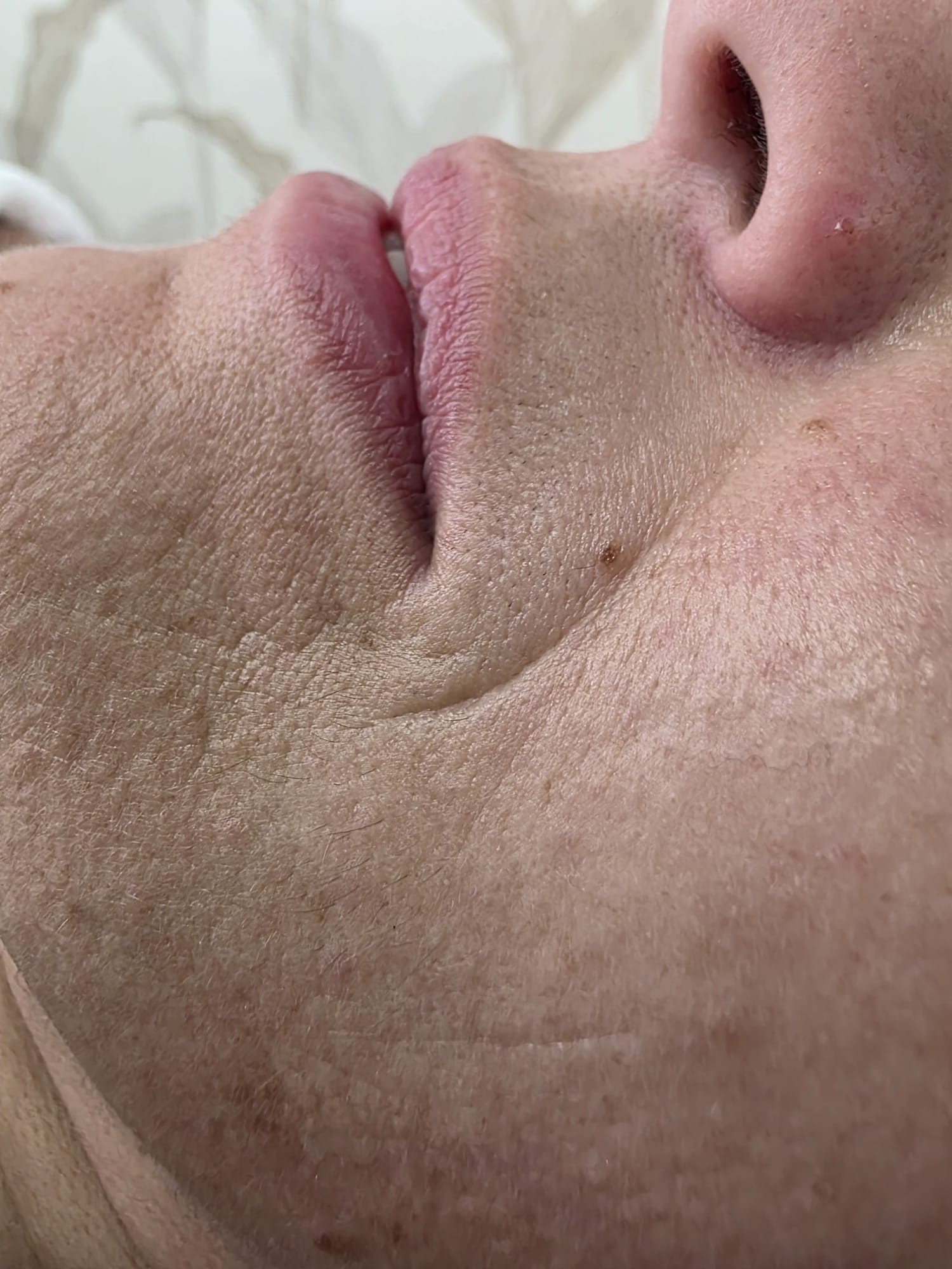 Antes — Rejuvenescimento Facial Opatra — zona da bochecha
