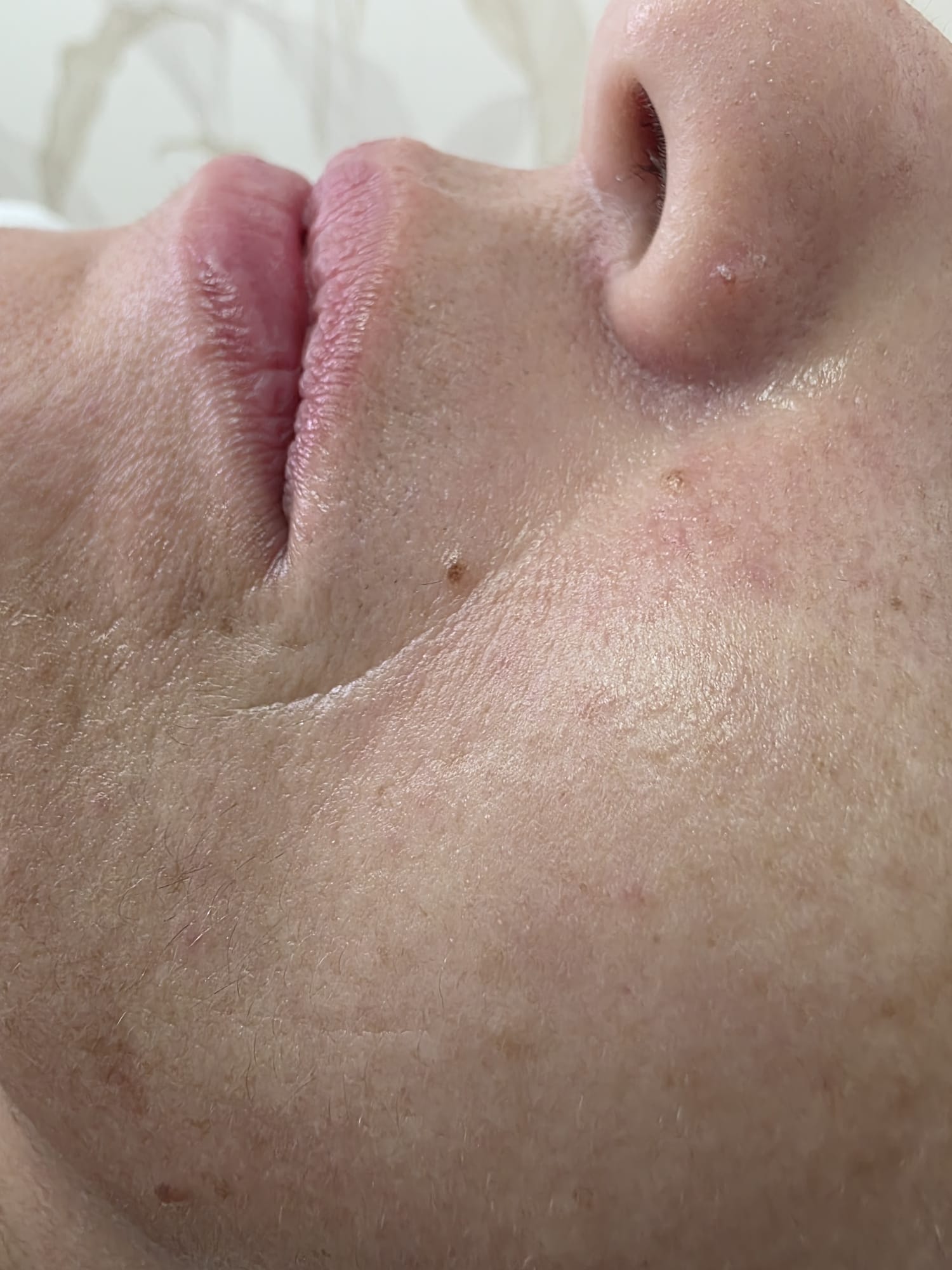 Depois — Rejuvenescimento Facial Opatra — zona da bochecha