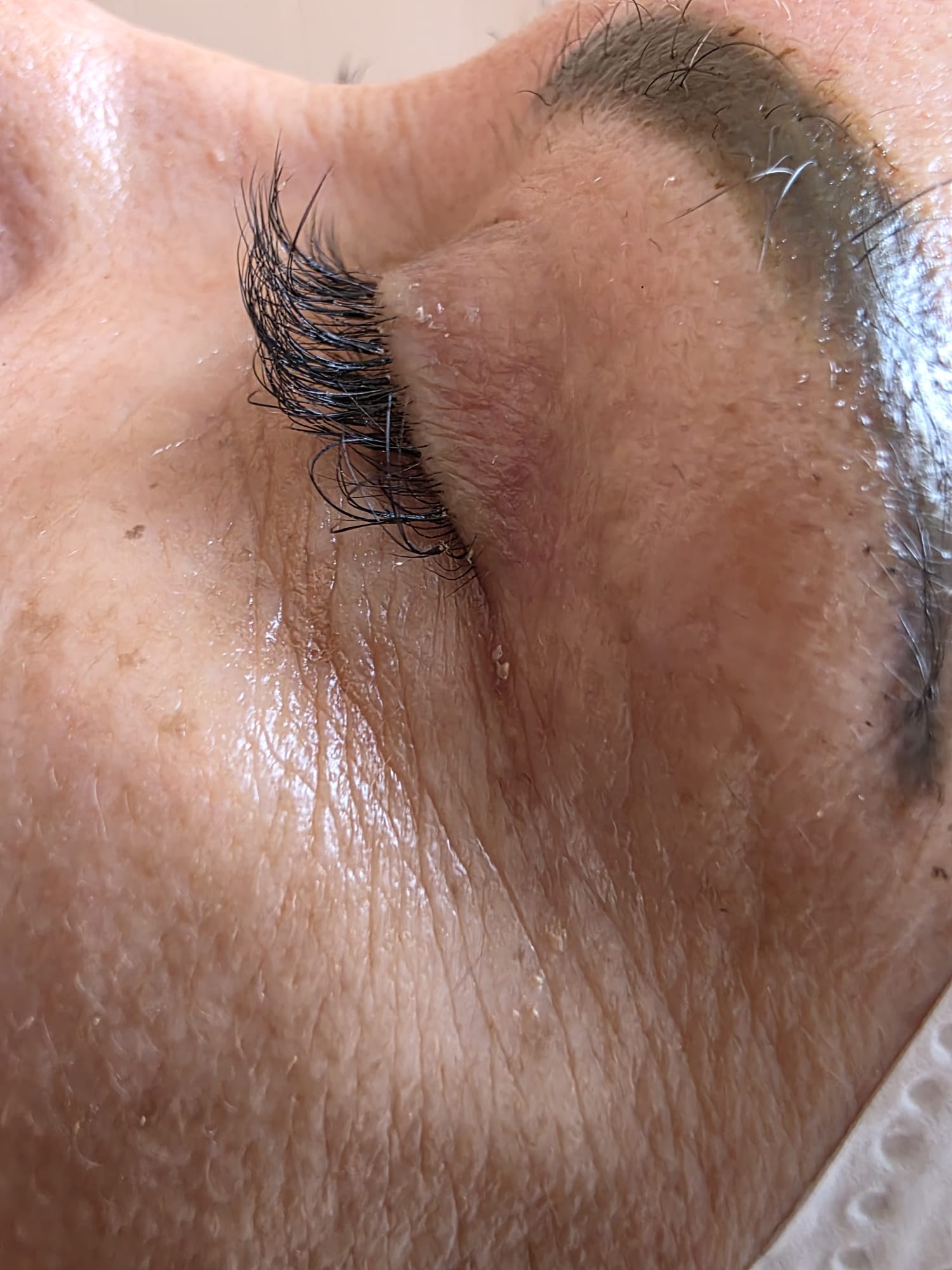Antes — Rejuvenescimento Facial Opatra — contorno de olhos