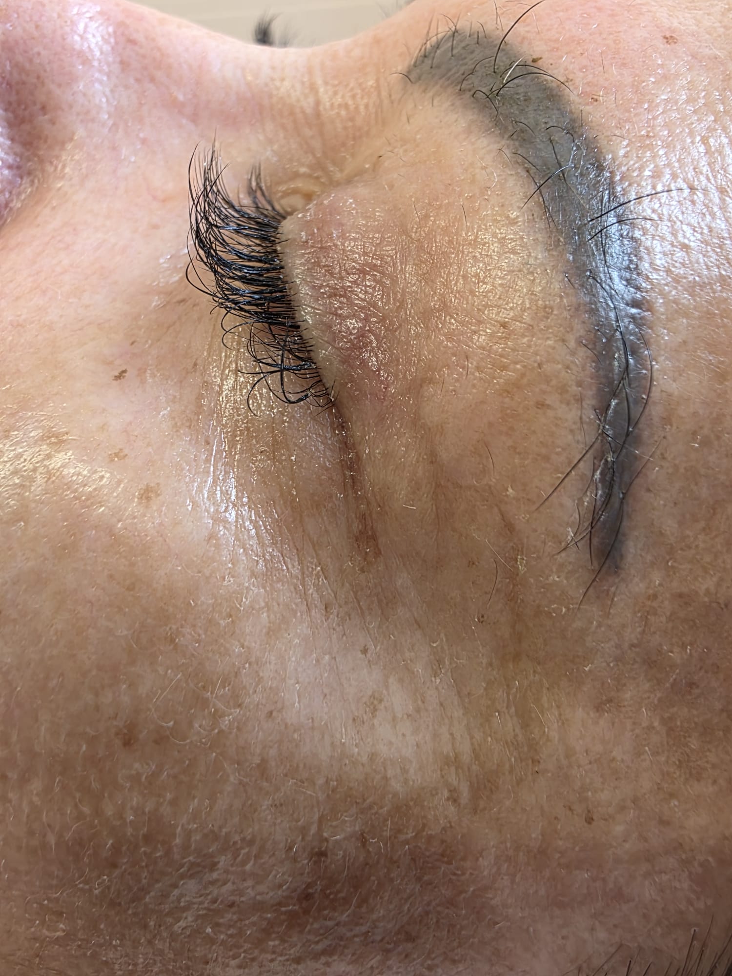 Depois — Rejuvenescimento Facial Opatra — contorno de olhos