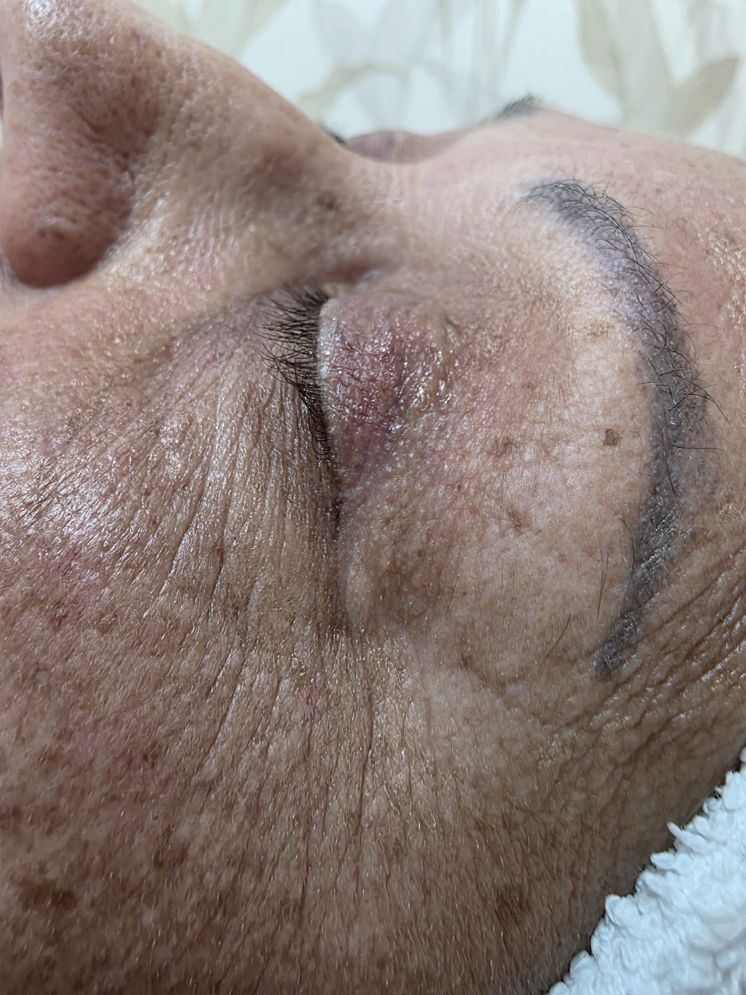 Antes — Rejuvenescimento Facial Opatra — contorno de olhos