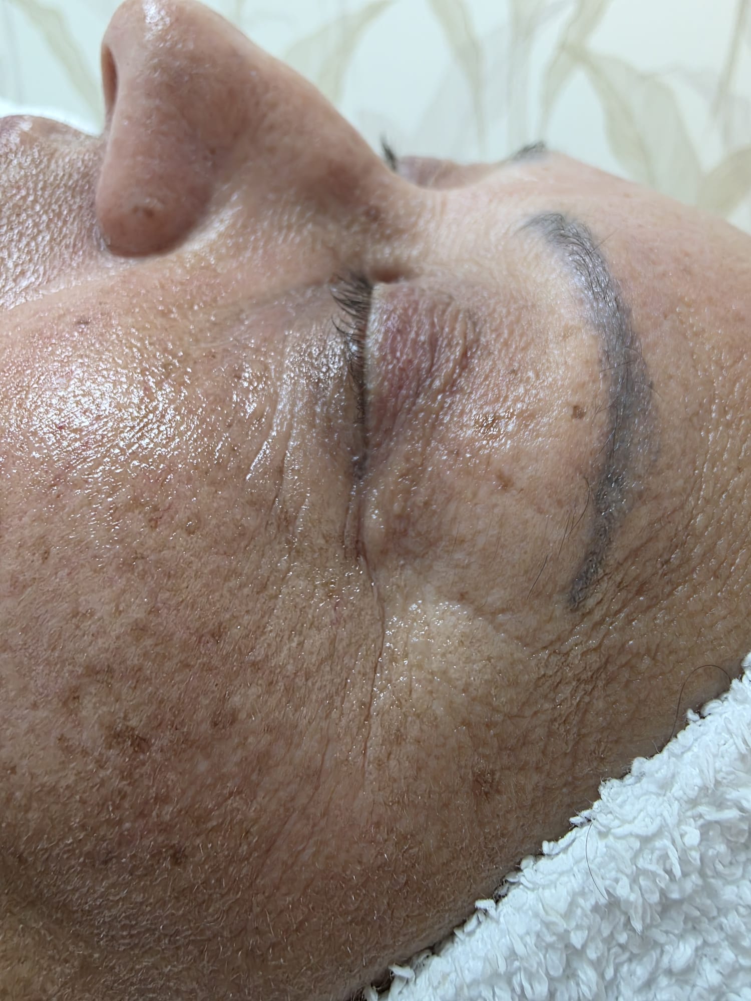 Depois — Rejuvenescimento Facial Opatra — contorno de olhos