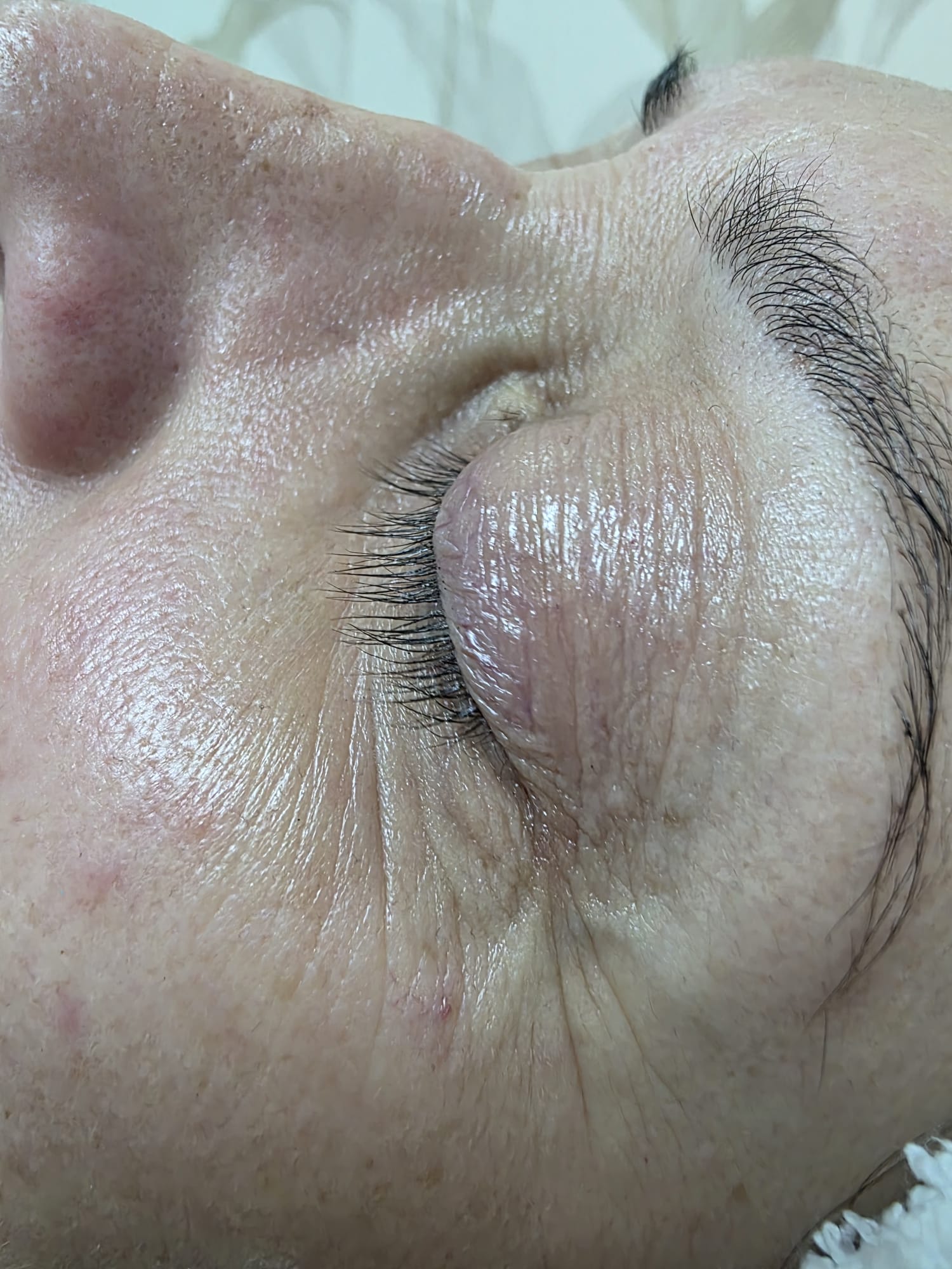 Antes — Rejuvenescimento Facial Opatra — zona periocular