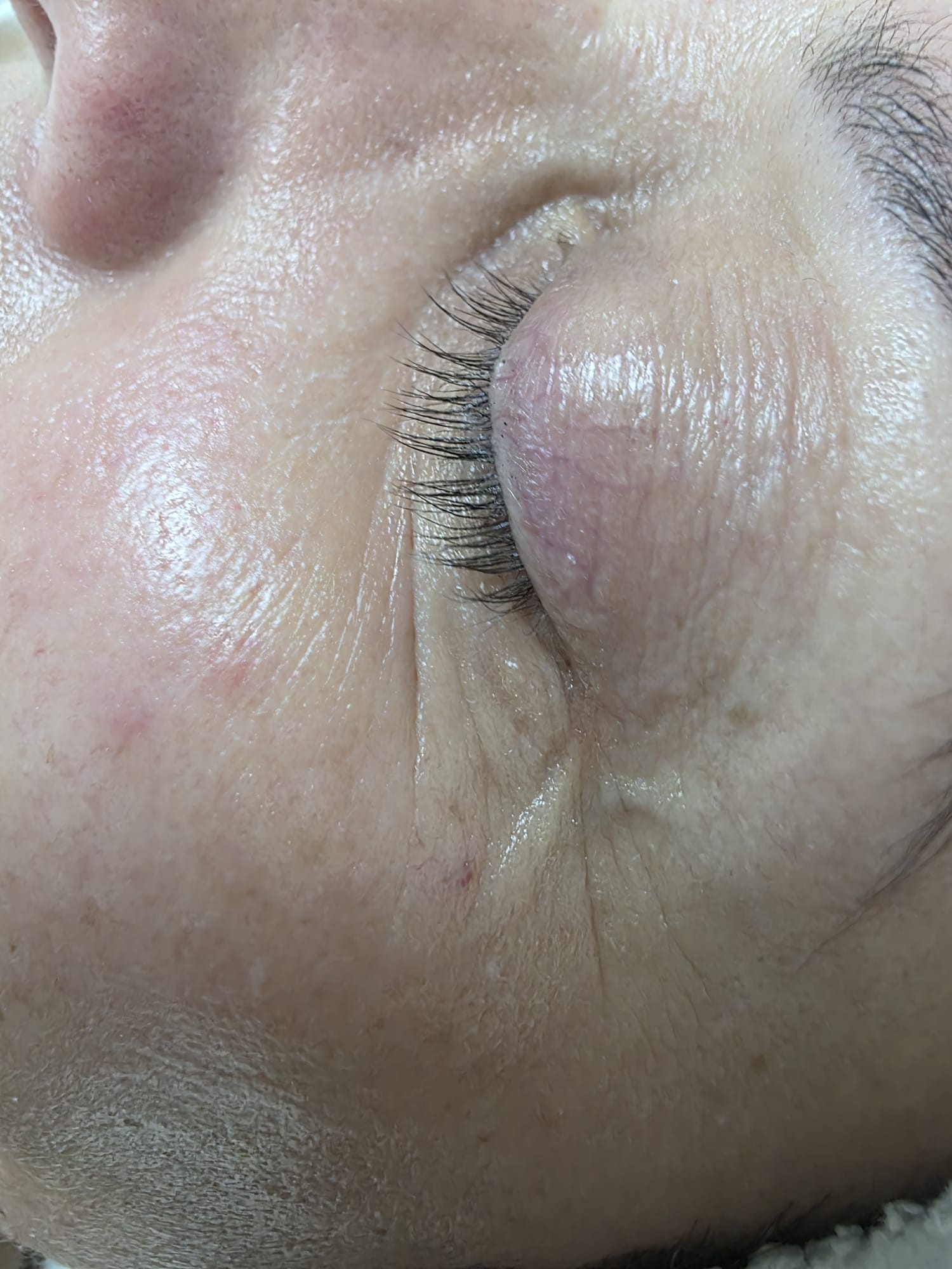 Depois — Rejuvenescimento Facial Opatra — zona periocular