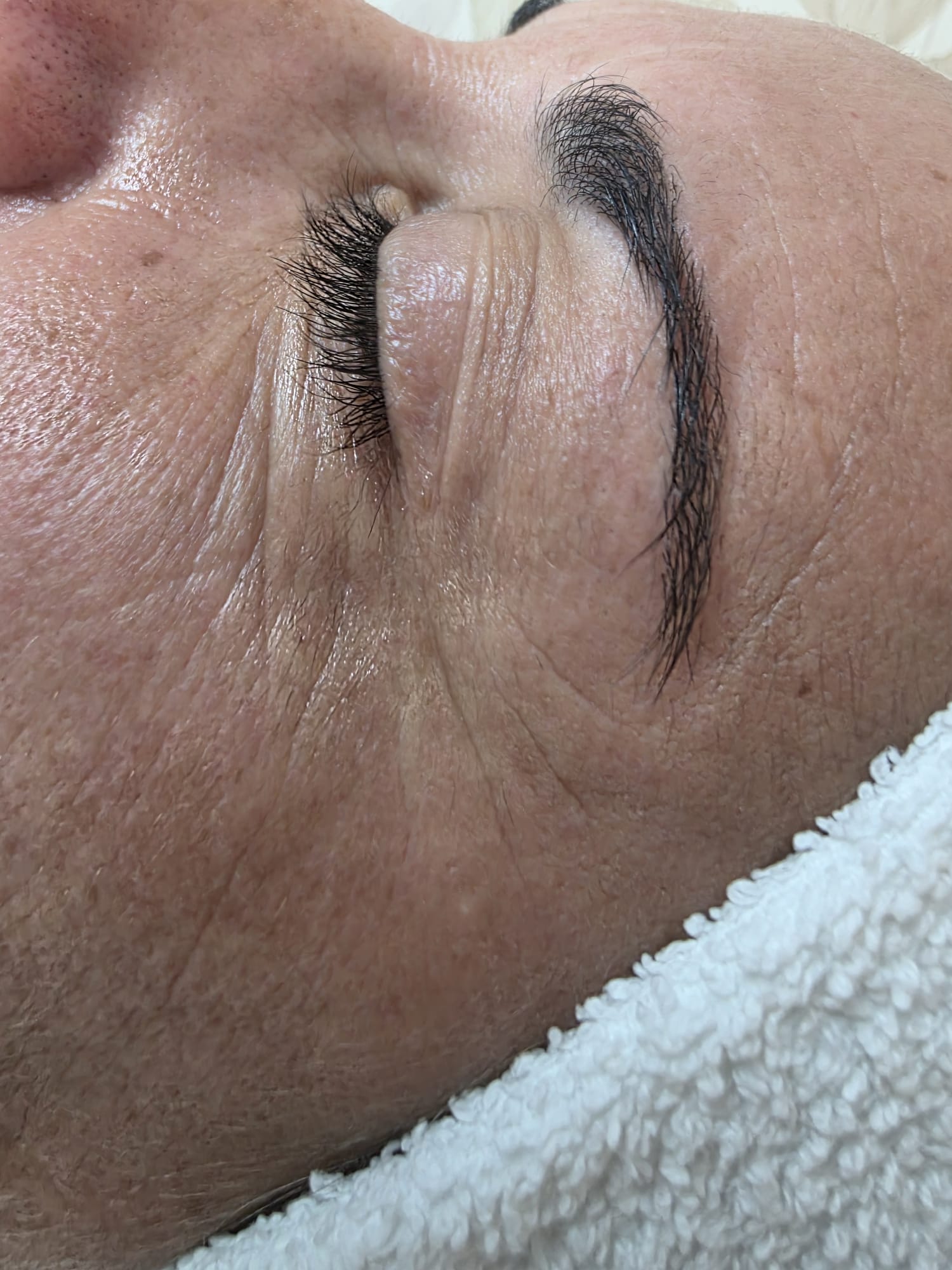 Antes — Rejuvenescimento Facial Opatra — zona periocular