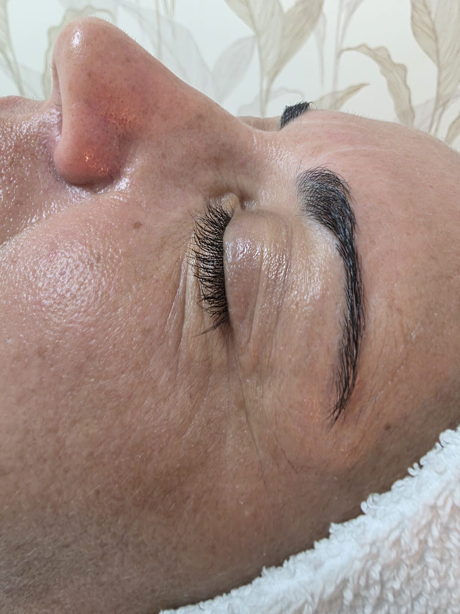 Depois — Rejuvenescimento Facial Opatra — zona periocular