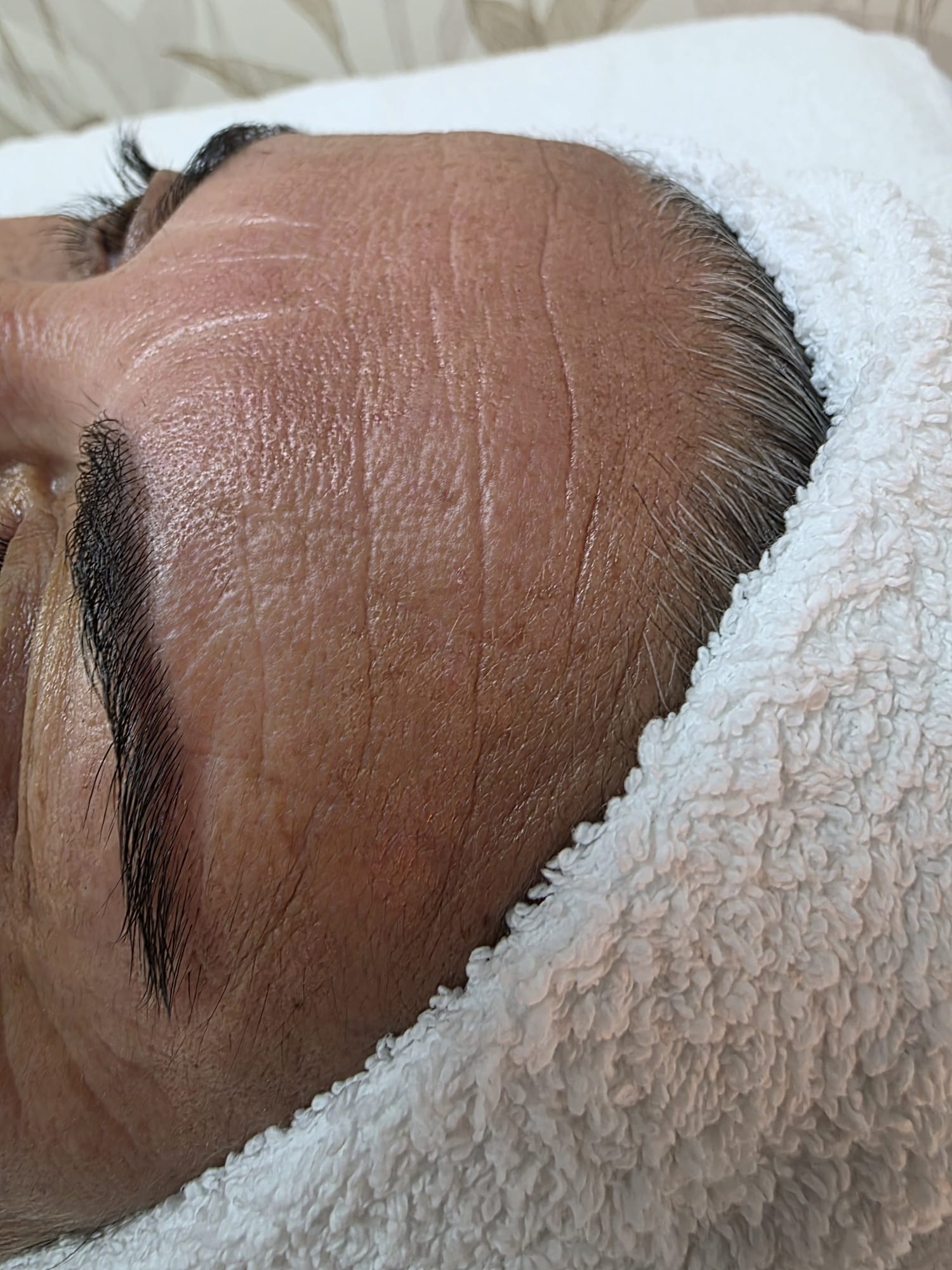 Antes — Rejuvenescimento Facial Opatra — testa