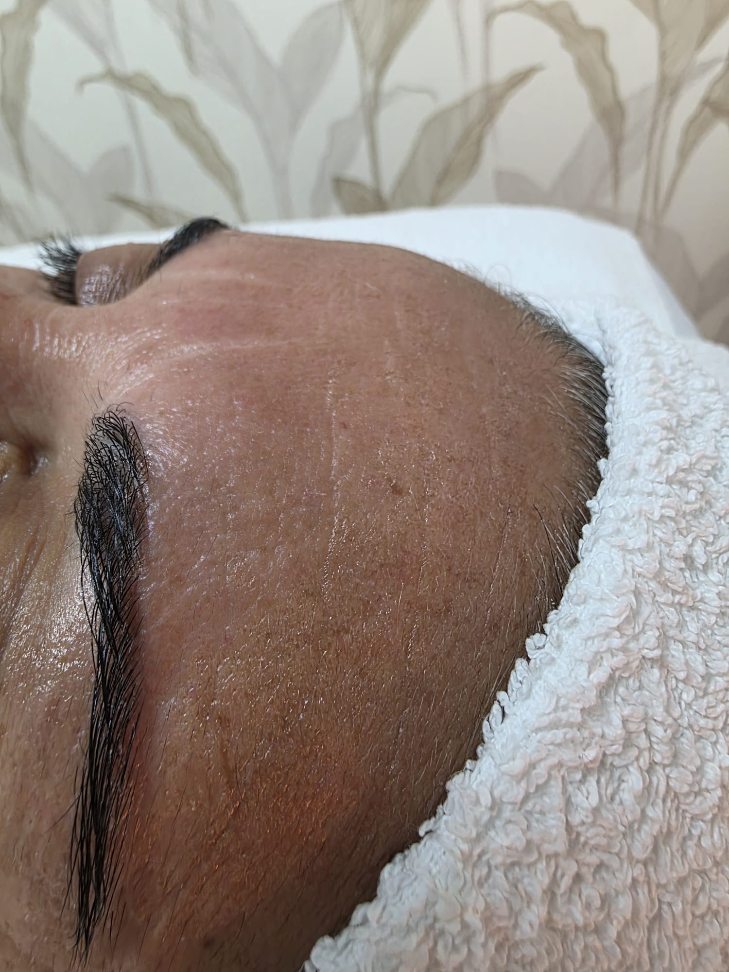 Depois — Rejuvenescimento Facial Opatra — testa